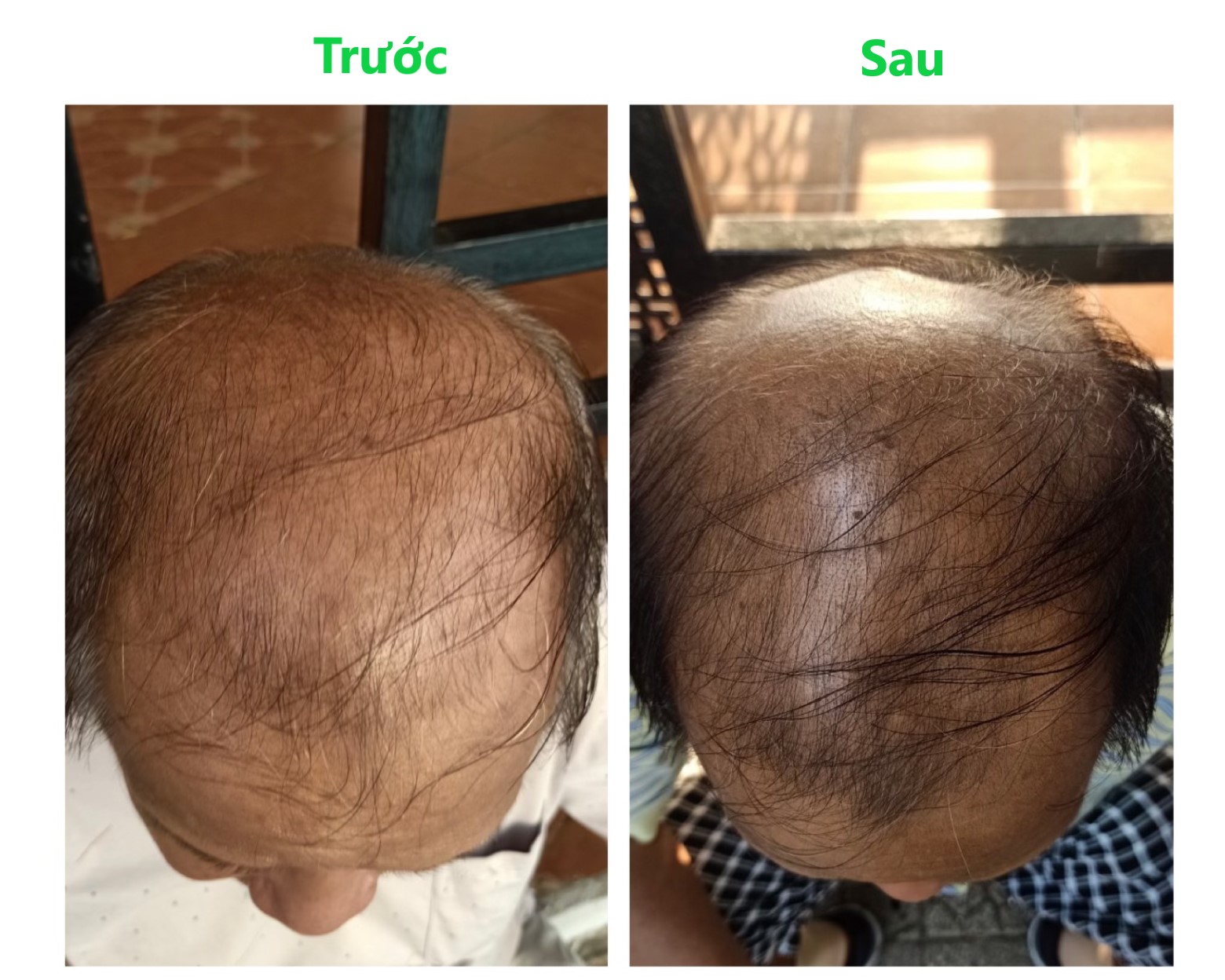 Serum kích thích mọc tóc Super Nano Hair - Kích thích mọc tóc, hạn chế rụng tóc