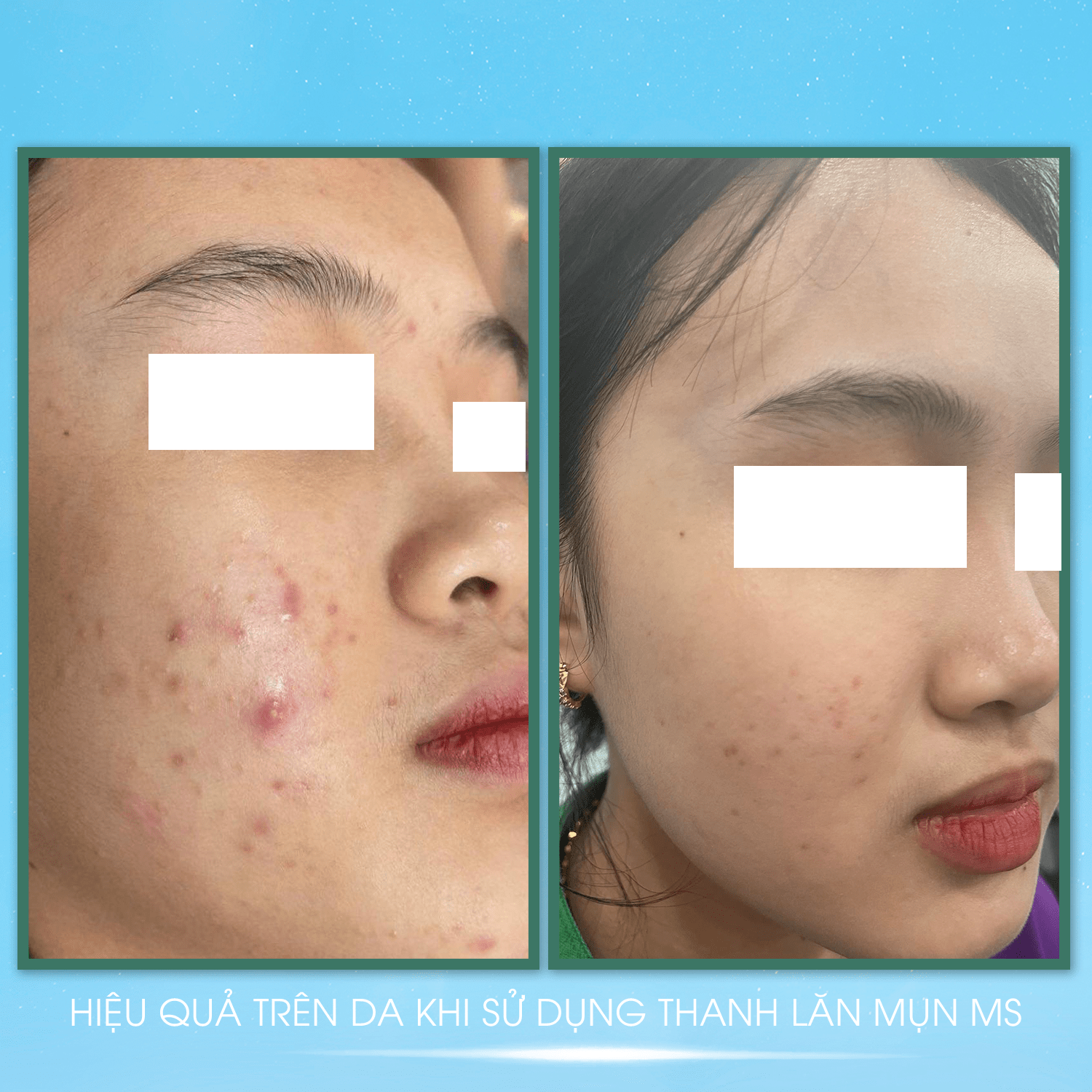 [Combo] 1 Thanh Lăn Mụn MS 5ml + 1 Serum Phục Hồi Da Hyaluronic Acid B5 - JOA GREEN (TẶNG 1 Sữa Rửa Mặt MS 150ml) - MỸ PHẨM MS COSMETIC