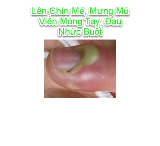 Thảo dược bôi nấm ngứa, tổ đỉa, hắc lào, lang ben, vảy nến, á sừng, zona các vấn đề về da_1 hộp 20 gói (Đông Y Cổ Truyền)