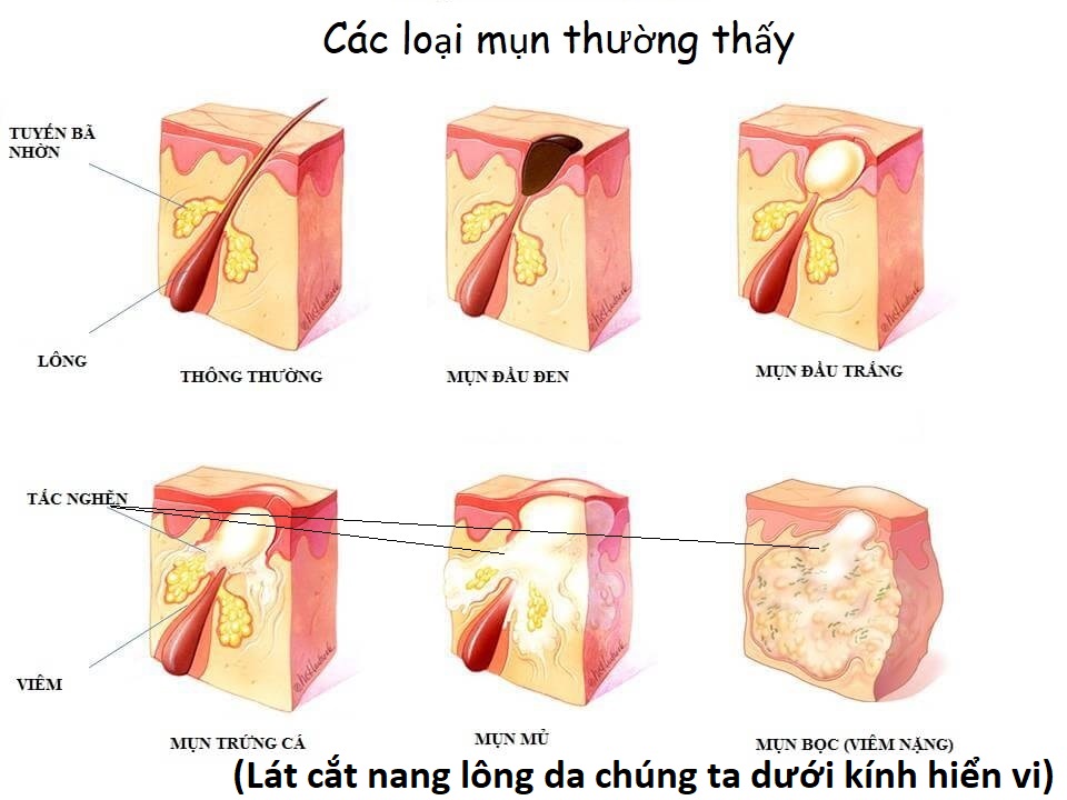 Kem da liễu bôi mụn thịt, mụn cơm, mụn cóc, nốt ruồi, thành phần thảo dược an toàn giá rẻ_HBESTY