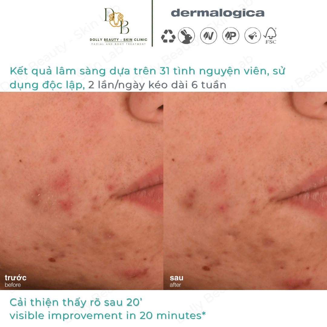 Dưỡng ẩm dành riêng cho da mụn ACNE BIOTIC MOISTURIZER giúp ngăn ngừa mụn tái phát của Dermalogica