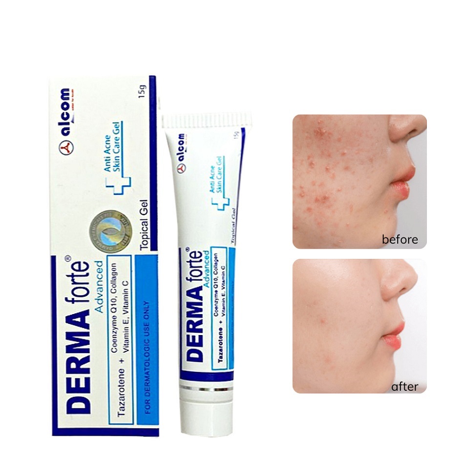 Gel Hỗ Trợ Giảm Mụn, Thâm Sẹo Và Dưỡng Da Gamma Derma Forte Gel 15g - Bản Advance