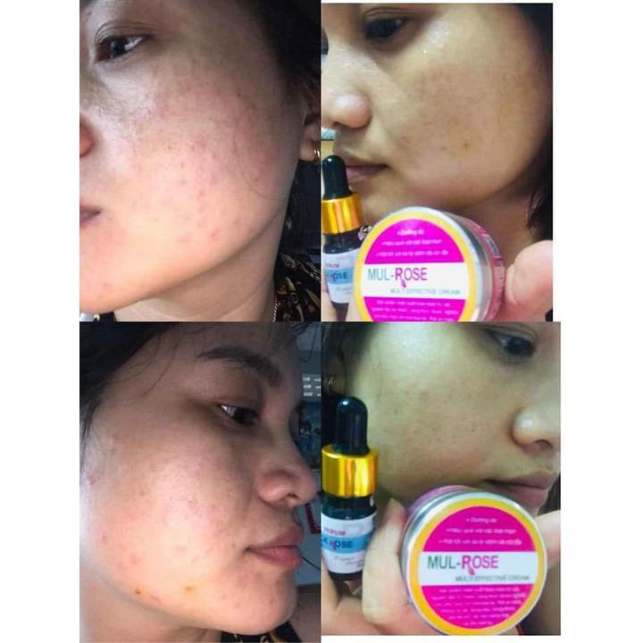 COMBO SERUM BLACK ROSE 20ml & KEM MULROSE 5 gr