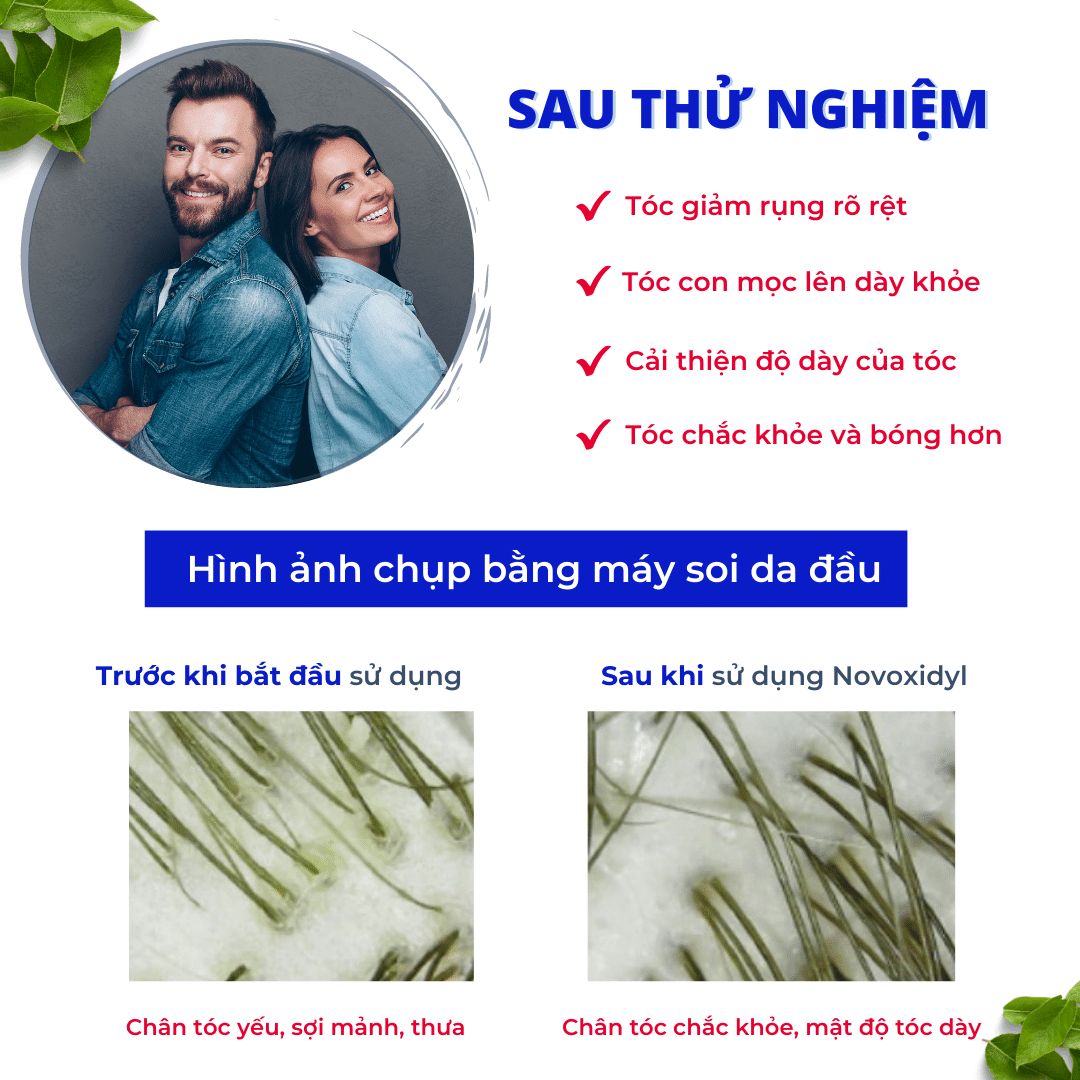 Serum Y Tế Novoxidyl ngăn ngừa rụng tóc và thúc đẩy mọc tóc mới chai 75ml