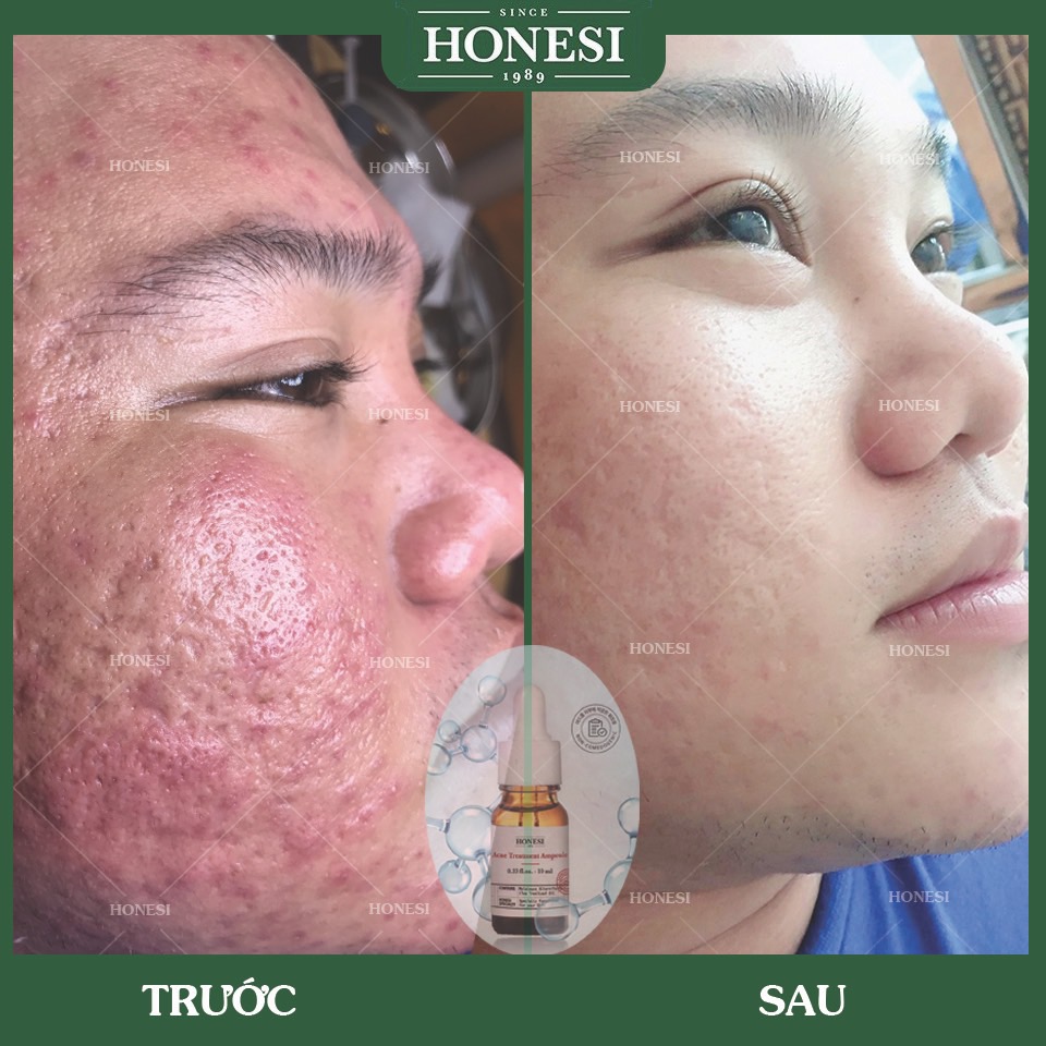 Sét Serum Giảm Mụn Nhanh Lành Tính HONESI Acne Treatment Ampoule (10ml x 5 lọ) - Hàn Quốc