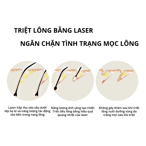 Máy triệt lông tại nhà công nghệ IPL, bóng đèn thạch Anh 100%, công nghệ Mỹ LUX HAIR