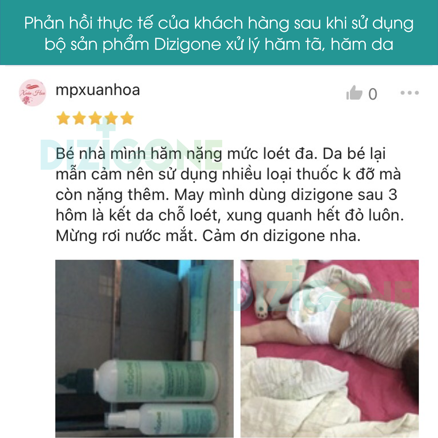 [Bộ đôi] Xịt kháng khuẩn DIZIGONE chăm sóc tổn thương lành nhanh, không đau xót, tái tạo da, ngăn ngừa sẹo (2 chai x 100ml)