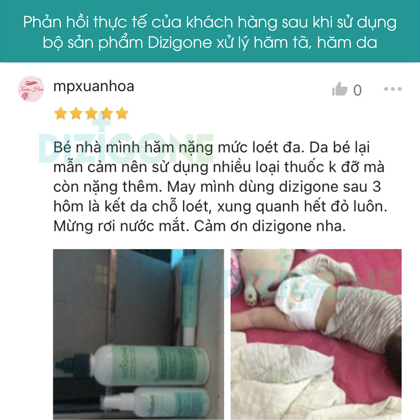 Xịt kháng khuẩn DIZIGONE chăm sóc tổn thương lành nhanh, không đau xót, tái tạo da, ngăn ngừa sẹo - 3 chai 100ml