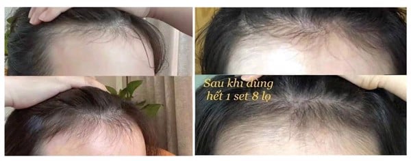 huyết thanh kích mọc và làm dày tóc weilaiya ginger hair root nourishing essence ( 1 lọ lẻ 5ml, không hộp) 5