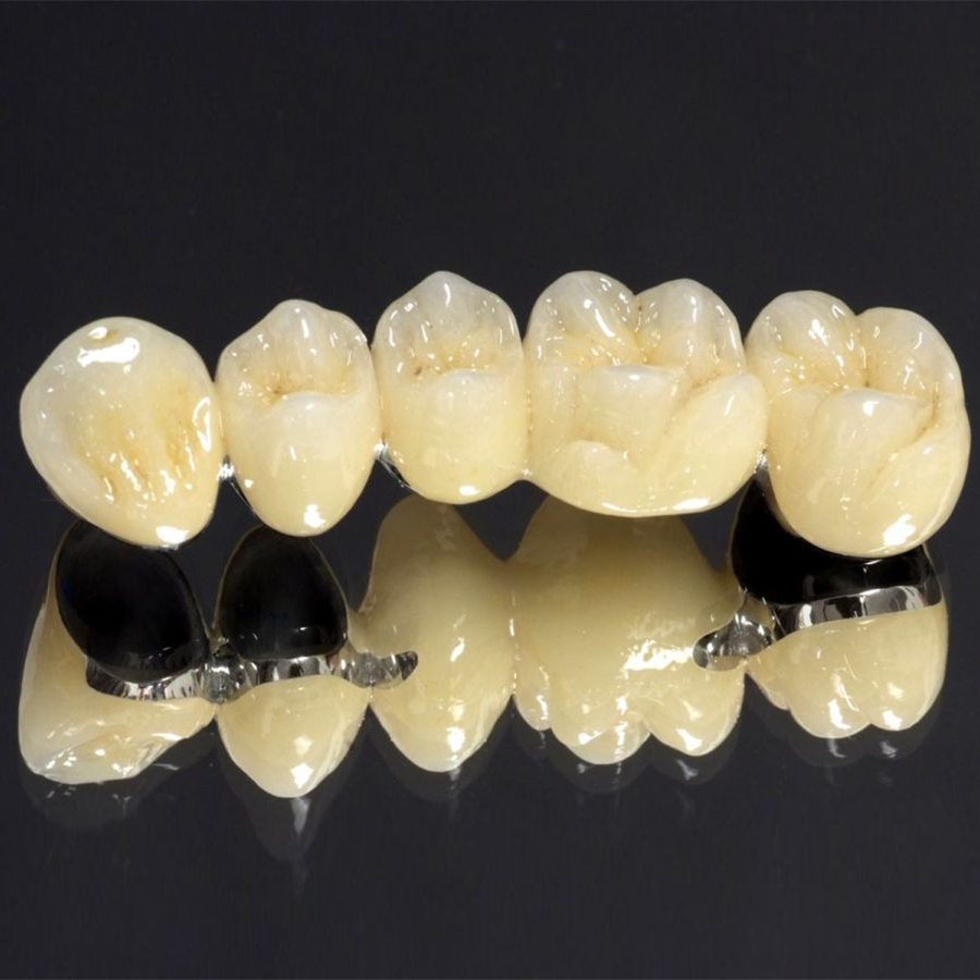 Bọc 1 răng mặt dán sứ Emax/Cercon HT tại Nha Khoa Gia Hân