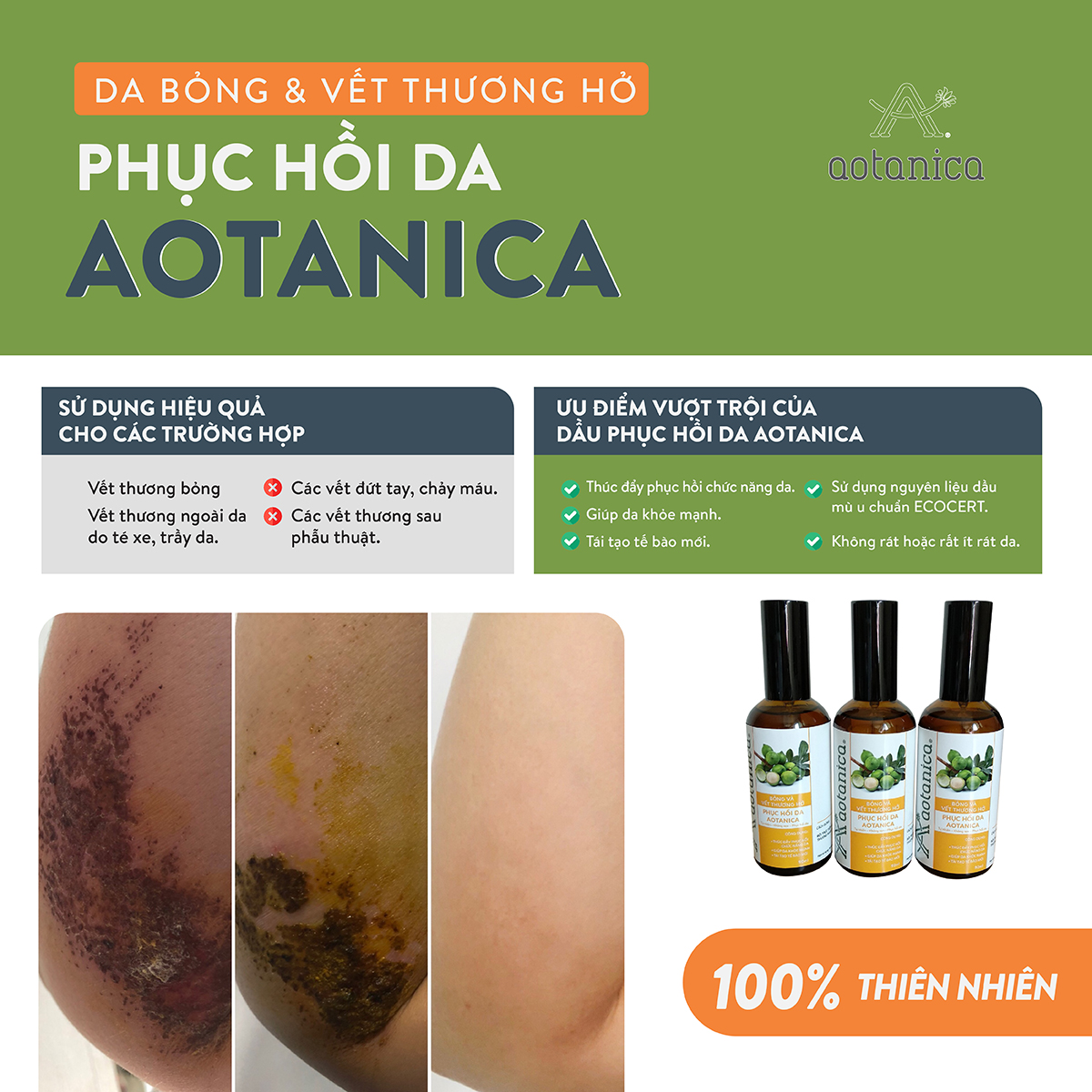 Dầu phục hồi da bỏng &amp; vết thương hở Aotanica 20ml