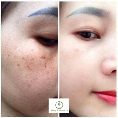 Bộ sản phẩm KEM SÂM ĐẾ VƯƠNG OLIC chống lão hóa da cao cấp, Xóa thâm da, sạm da, làm sạch tàn nhang trên da còn làm trắng da, trẻ hóa làn da, lấy lại tuổi thanh xuân.
