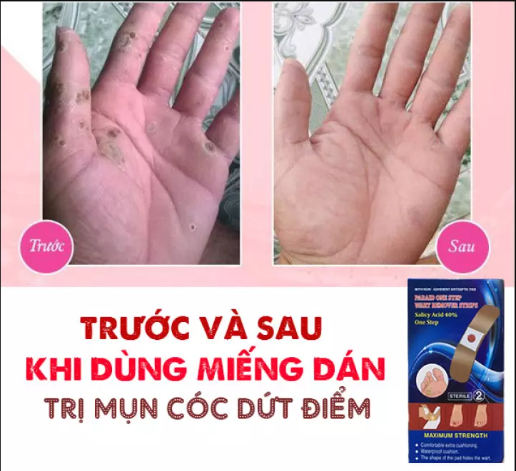 Miếng Dán Mụn Cóc Mụn Cơm Sterile (hộp 6 miếng), hỗ trợ xóa mờ mụn thông thường trên da