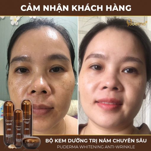 Tinh chất nước thần tái tạo Luxury Exosome Essence 100ml, phiên bản nâng cấp từ Nước hoa hồng hỗ trợ mờ nám Puderma White Jade Toner 100 ml: chống lại sự lão hóa da, giảm sự hình thành các nếp nhăn.