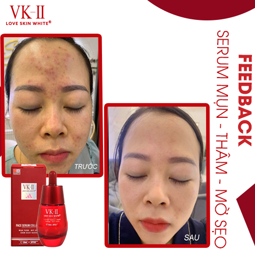 Serum Ngừa Mụn - Thâm - Mờ Sẹo - Kiểm Soát Nhờn VK II