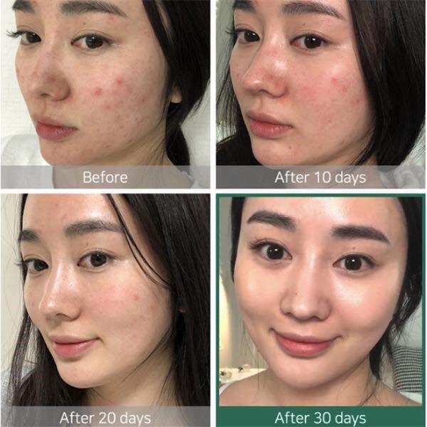 Bộ 3 SP Hỗ Trợ Giảm Mụn Some By Mi AHA-BHA-PHA 30 Days Miracle