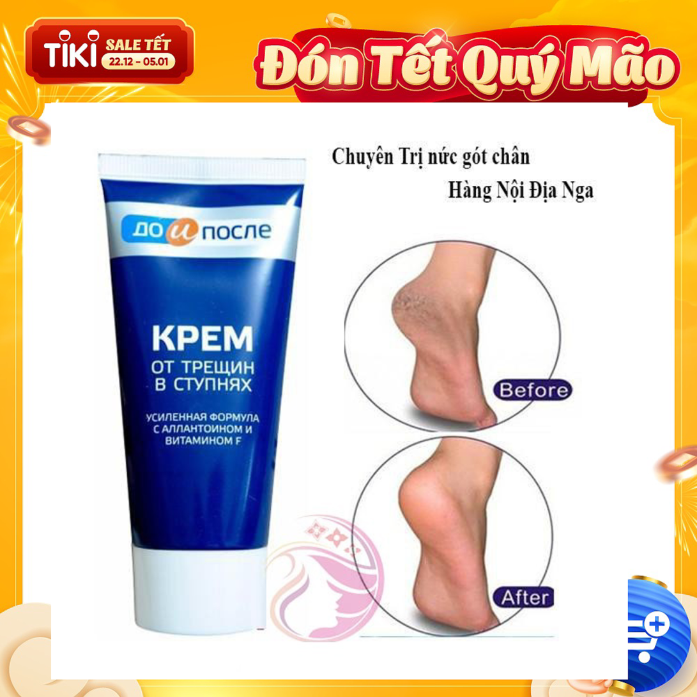 Kem dưỡng ngăn ngừa nứt gót chân Kpem Cream for Carcks in the feet 50ml