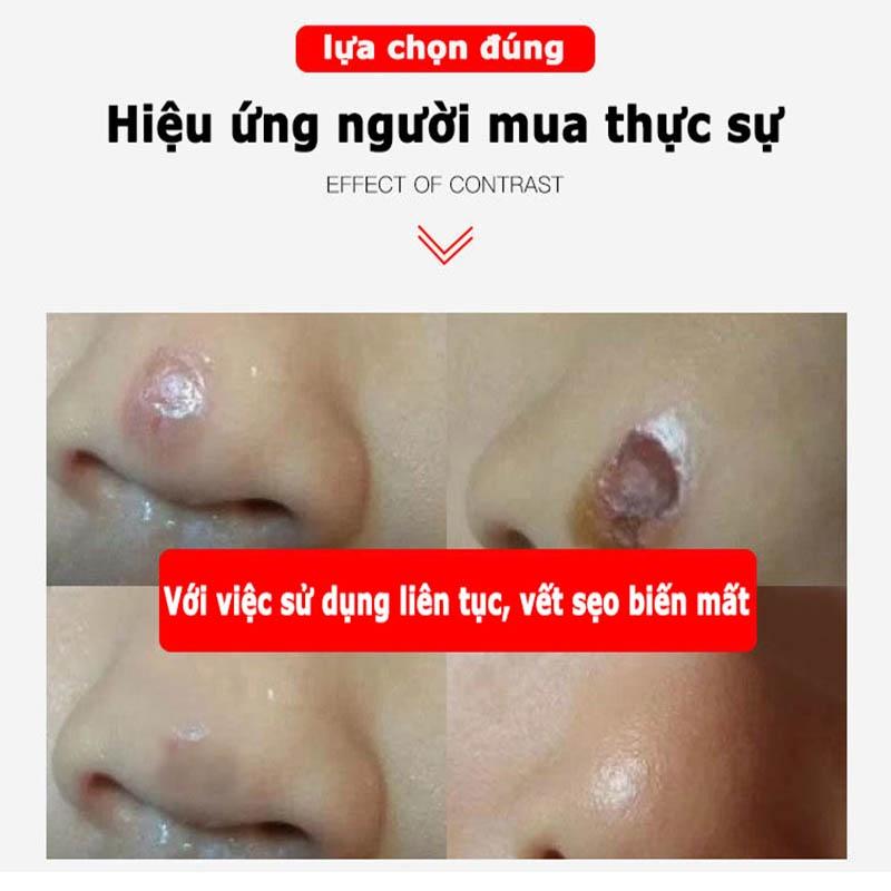 Kem xóa sẹo, loại bỏ hiệu quả các vết sẹo lâu năm, sẹo phẫu thuật, phục hồi và làm sáng các vết rạn da khi mang thai, xó