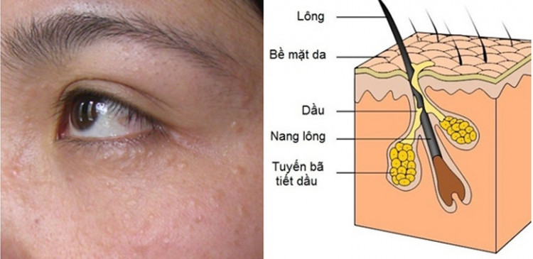 mun-thit-nguyen-nhan-mun-thit-la-do-dau-bevita
