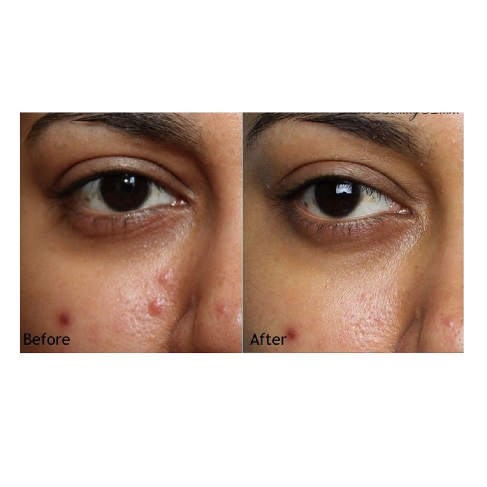 Kem Giảm Mụn La Roche-Posay Effaclar A.I. Targeted Imperfection Corrector  + Tặng 1 Móc Khóa Nhựa 2 Mặt