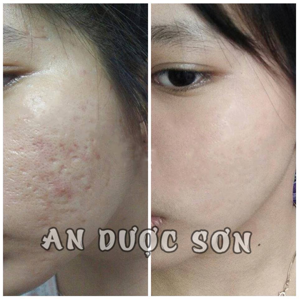 Combo Serum ngừa mụn thâm sẹo rỗ An Dược Sơn 30ml + Bột rửa mặt an dược sơn