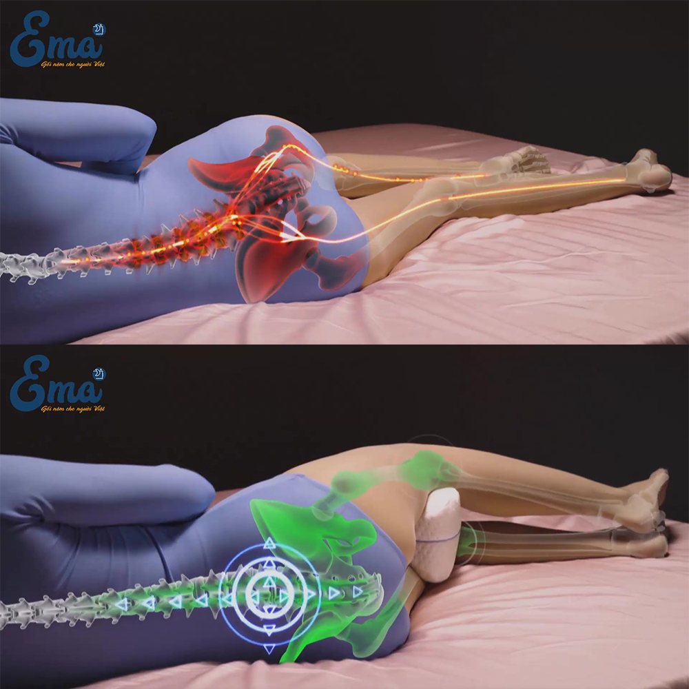 Gối kẹp chân thế hệ 2 Ema - Giảm đau đầu gối, hông và lưng, tăng cường lưu thông máu, chống giãn tĩnh mạch - Tốt cho người cao tuổi, phụ nữ có thai, chấn thương chân