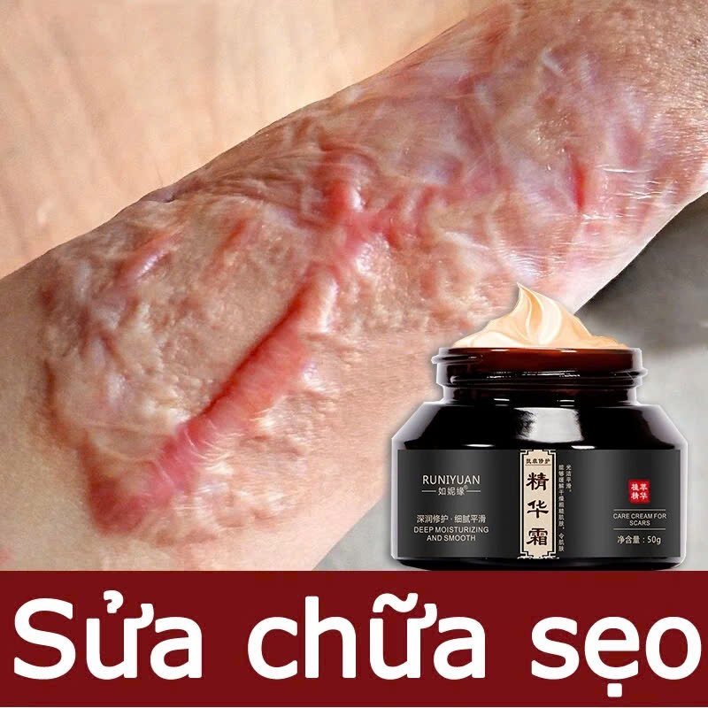 Kem Bôi Xóa Mờ Sẹo Thâm, Sẹo Lồi, Mụn Và Bỏng Hiệu Quả Nhanh Chóng Loại Tốt Hiện Nay
