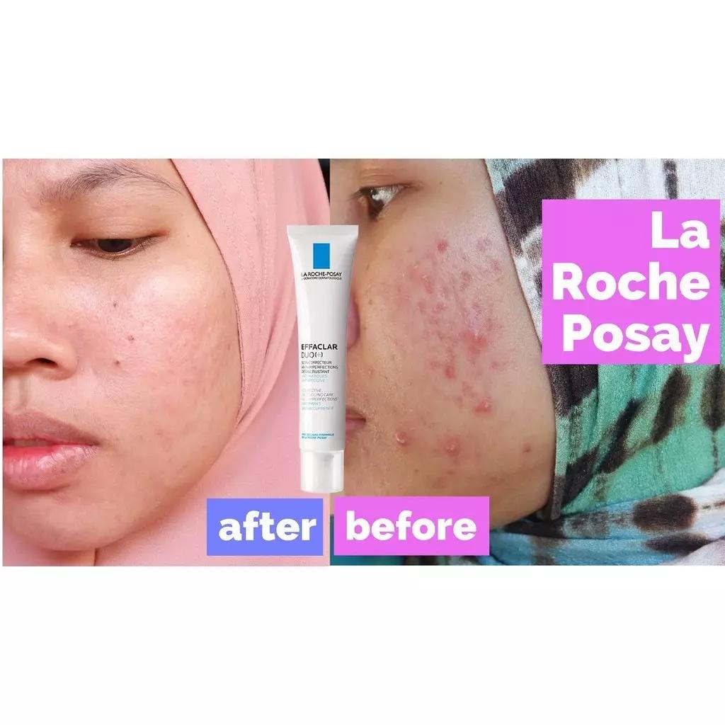 Kem dưỡng La Roche Posay giảm mụn Effaclar DUO+