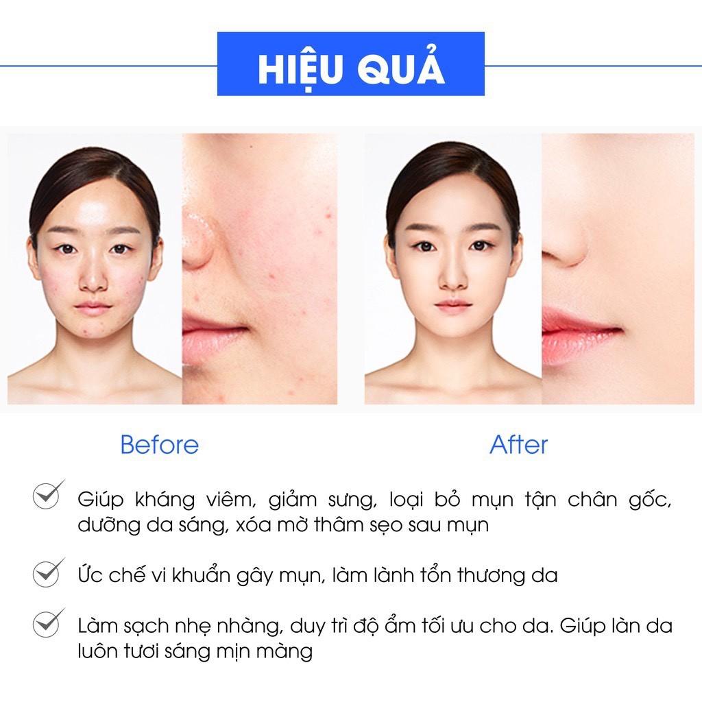 Bộ sản phẩm ngừa mụn Acosmetics: Kem Ngừa và Giảm Mụn + Sữa rửa mặt trà xanh X2