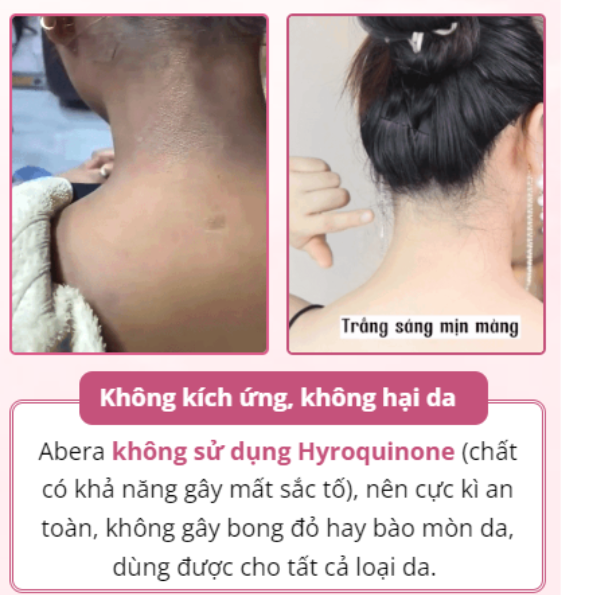 Kem Mờ Thâm Nách Abera 50ML- Mờ Giảm Thâm  Vùng Mông, Bẹn, Nách, Khuỷu Tay, Đầu Gối, Sau 21 Ngày