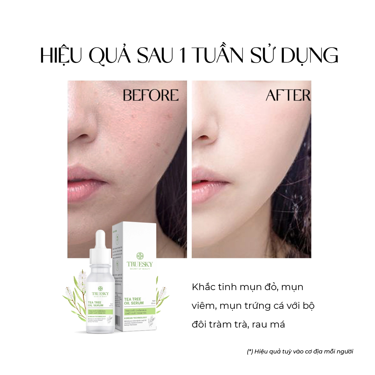 Tinh chất serum trị mụn Truesky Tea Tree Oil 10ml chiết xuất tràm trà