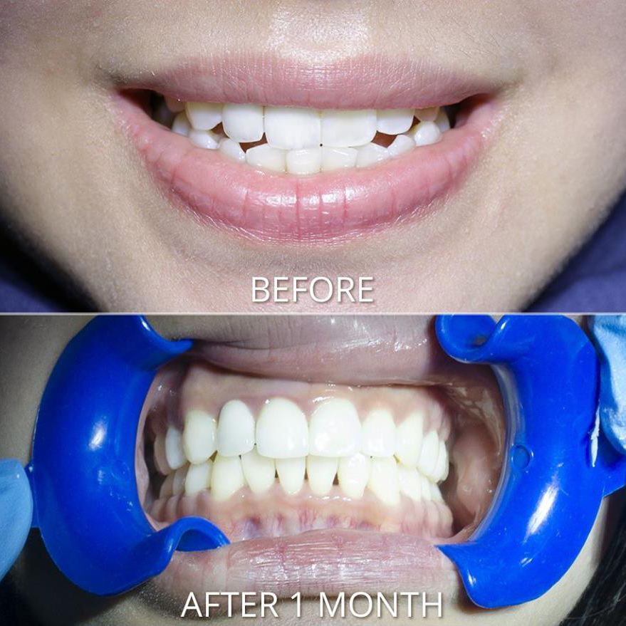 Hình ảnh Niềng Răng Siêu Tốc Trong 6 Tháng tại Navii Dental Care