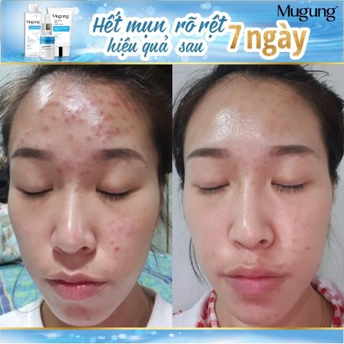 Serum giảm mụn Mugung 7 ngày hiệu quả giảm mụn đầu đen,mụn bọc (Làm xẹp không bong da) Acne Treatment 15ml