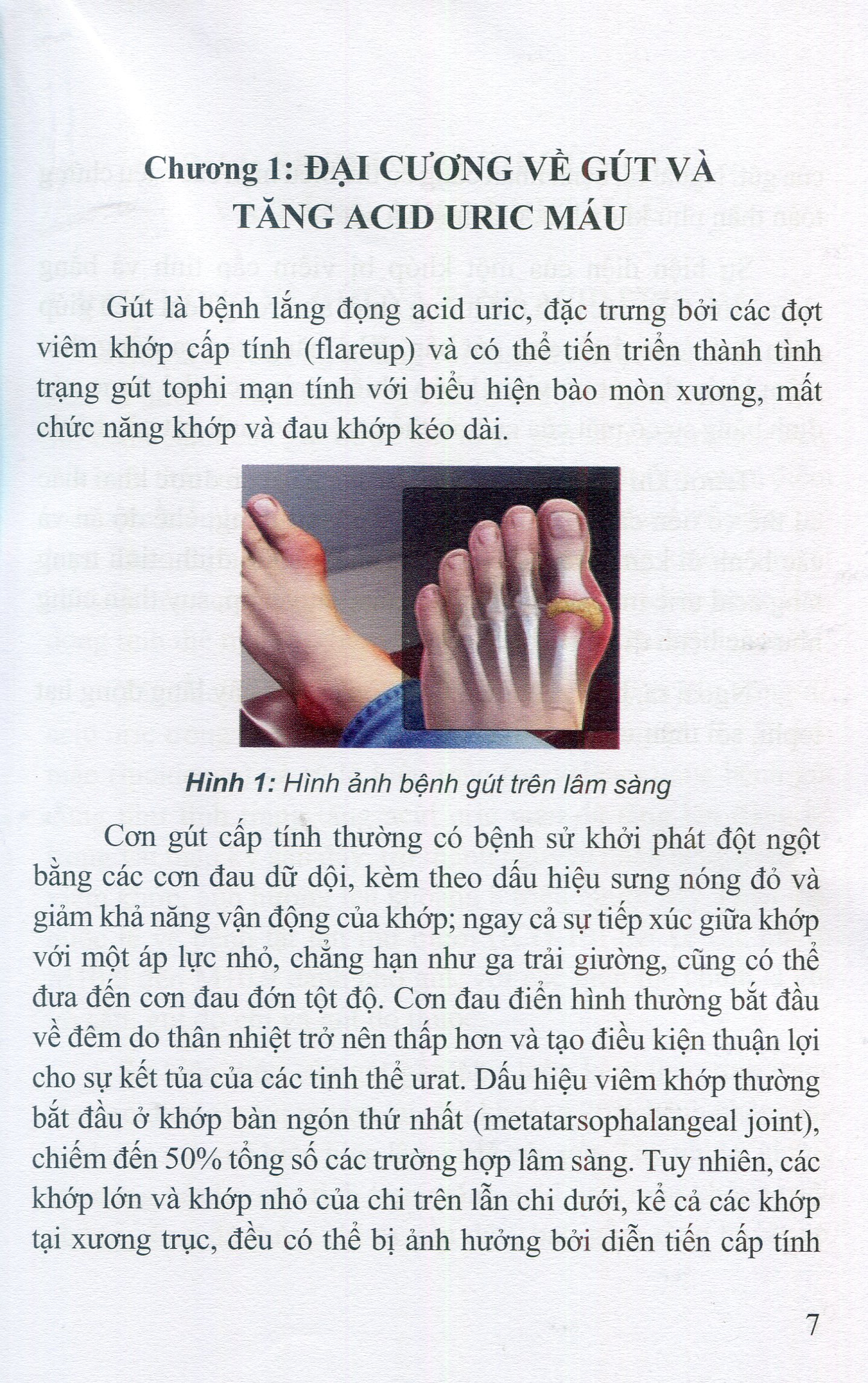 Bệnh Gút - Từ Khoa Học Cơ Sở Đến Thực Hành Lâm Sàng