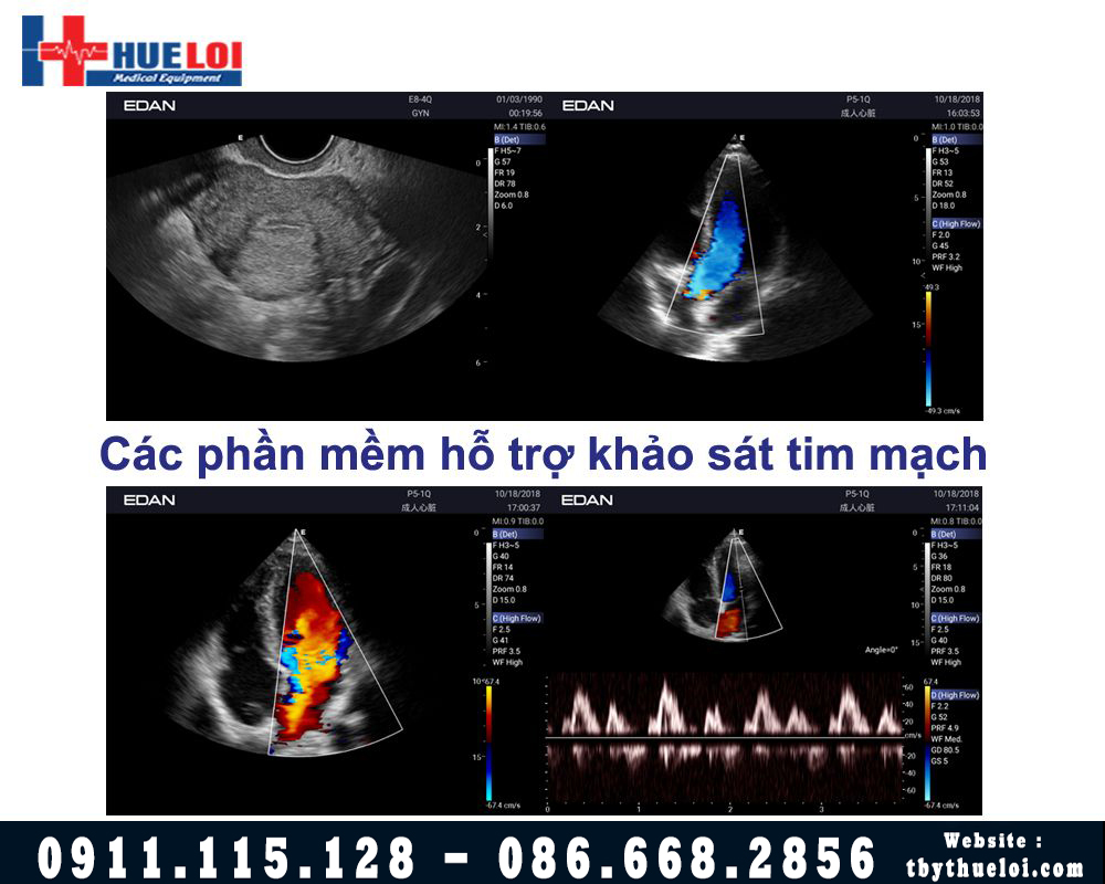 Máy Siêu Âm EDAN Xách Tay AX3