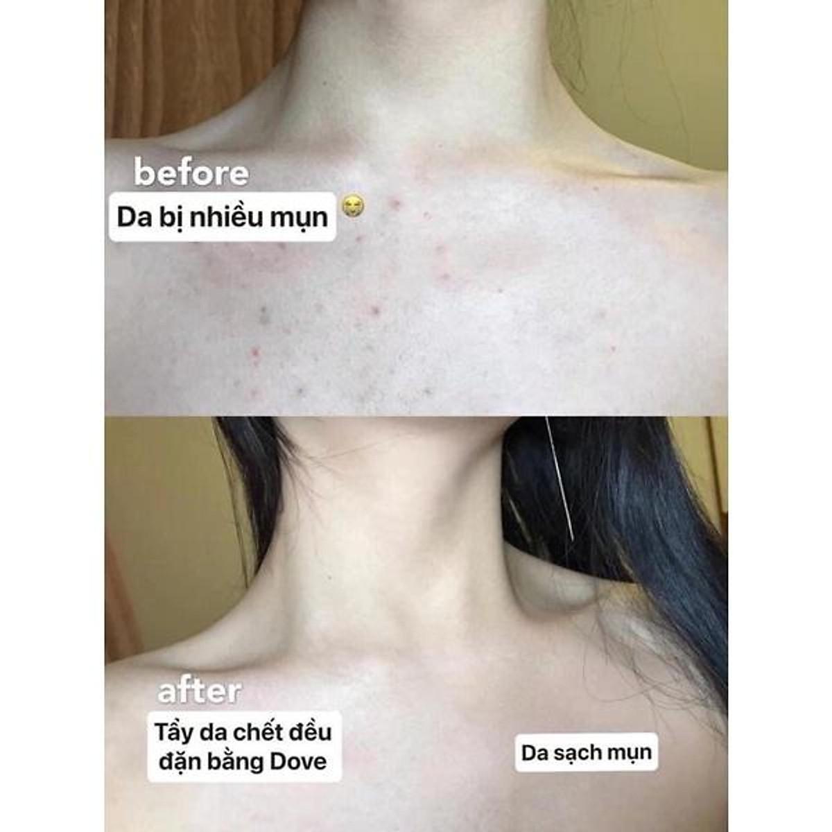 Tẩy Da Chết Dove Exfoliating Body Polish 225ml, Tẩy Tế Bào Chết, Làm Sáng Và Tái Tạo Da Mới, Nhập Đức