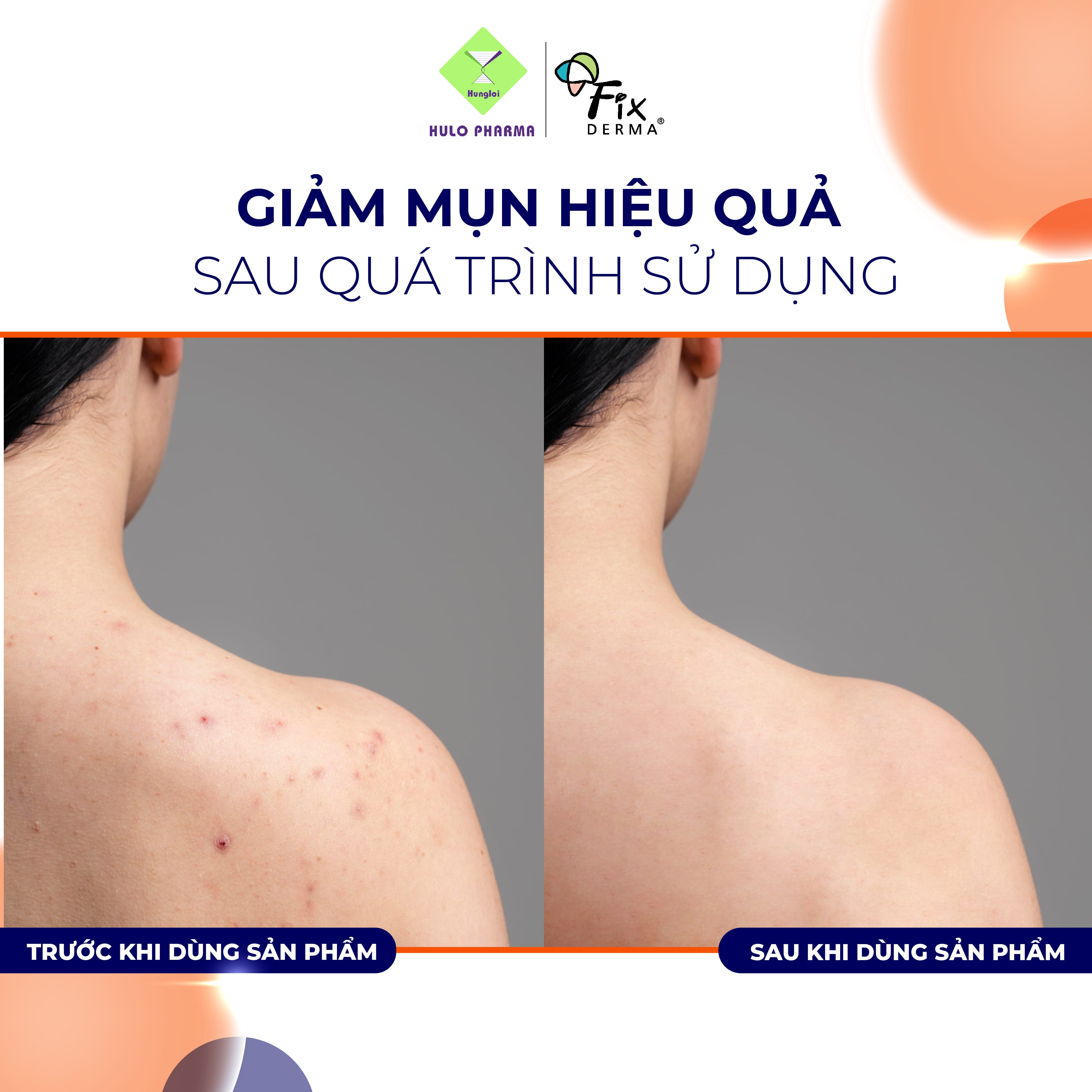 Xà Phòng Giúp Giảm Mụn Trứng Cá, Mụn Đầu Đen, Mụn Đầu Trắng, Giảm Thâm Mụn Fixderma Salyzap Soap 30g