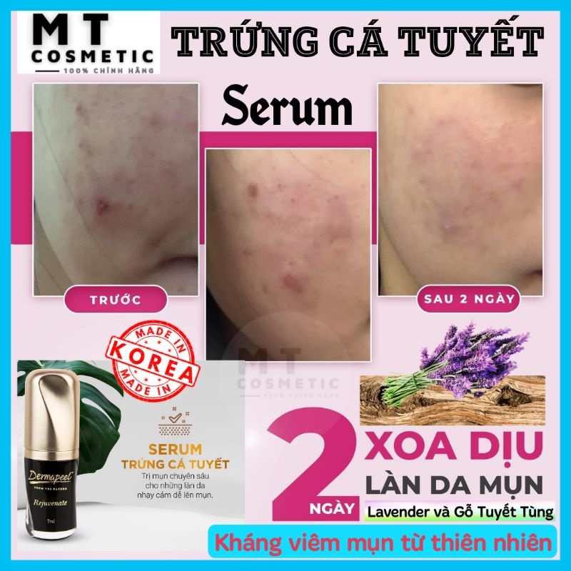 Serum trứng cá tuyết Dermapeel - sạch mụn - mờ thâm - da căng bóng trắng sáng sau 14 ngày