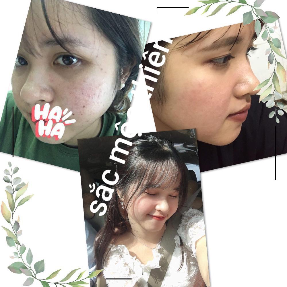 Bộ 3 Sản Phẩm Cải Thiện Mụn Siêu Tốc Sắc Mộc Thiên 30ml + 50gr + 100gr