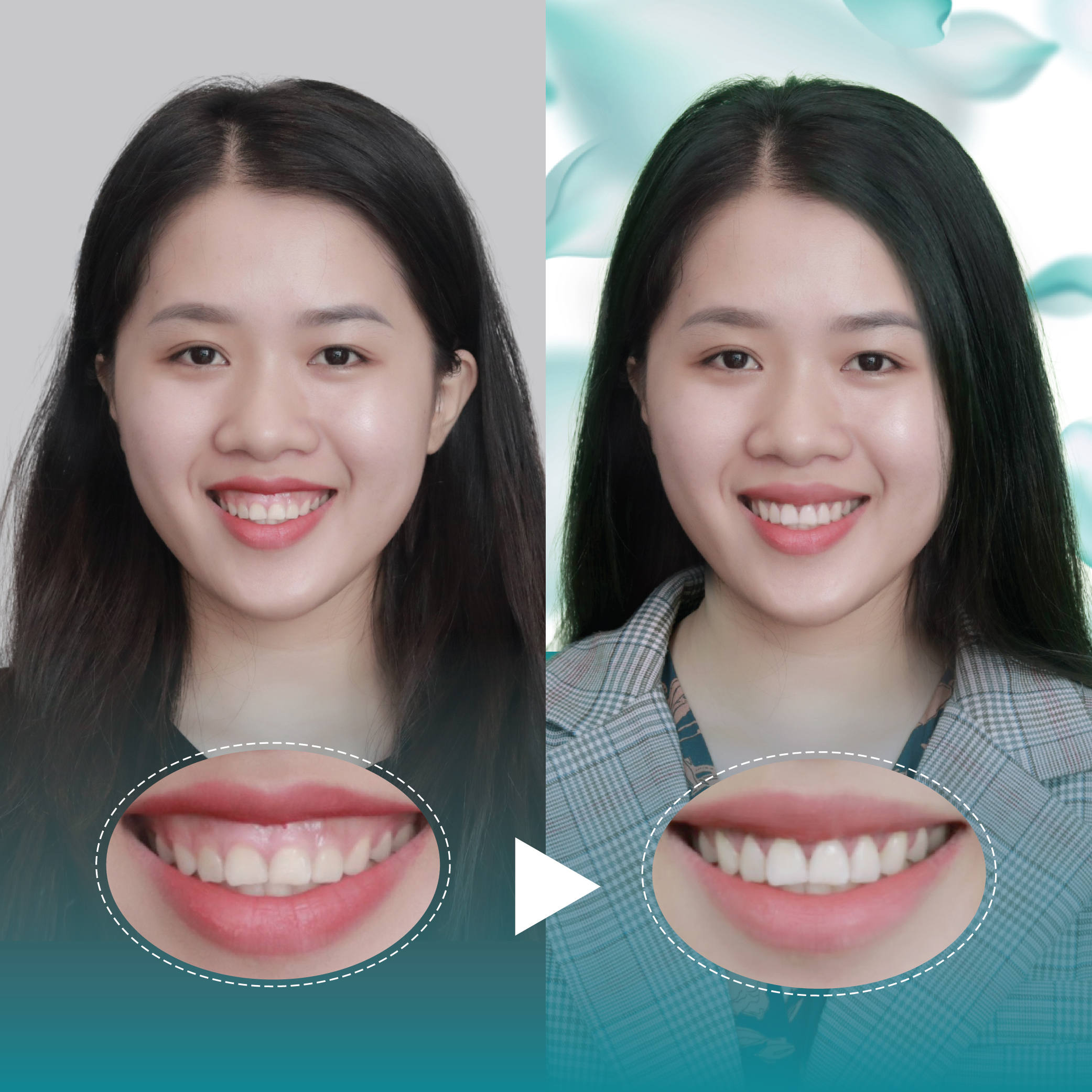 Điều trị dứt điểm hở lợi tại Nha Khoa Thẩm Mỹ Quốc Tế San Dentist