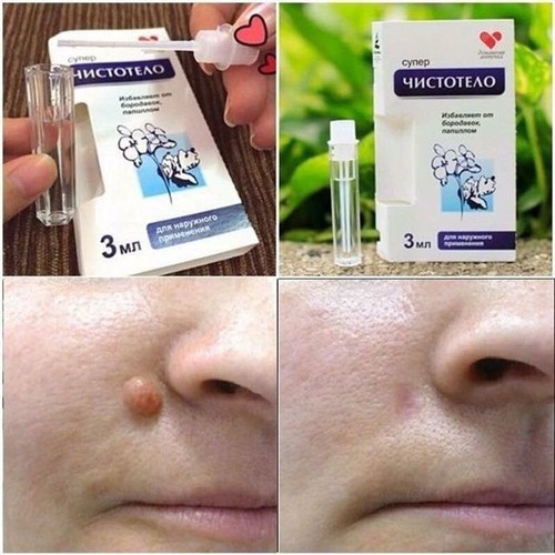 Combo tẩy nốt ruồi xóa mụn ruồi tại nhà Dvelinil nhập khẩu Nga và gel mờ sẹo Kem ngăn sẹo nga klirvin, kem ngừa sẹo, lồi, thâm, sẹo rỗ lâu năm, Serum tẩy nốt ruồi, mụn cóc, mụn thịt, tàn nhang, sẹo lồi Dvelinil