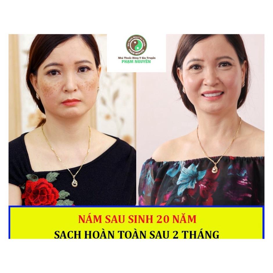 Kem nám tàn nhang, mụn, da thâm không đồng đều màu, kem gia truyền Phạm Nguyễn handmade