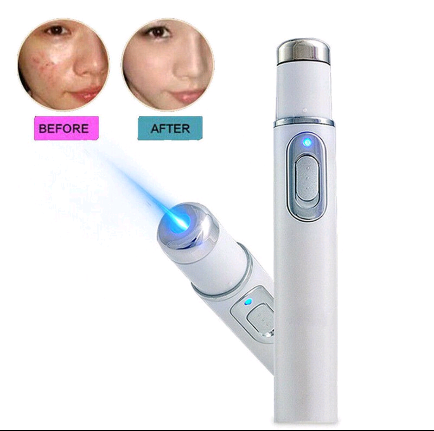 1 CÂY BÚT ĐIỆN TRỊ LIỆU XÓA MỤN TRỊ MỤN TÀN NHANG LASER BẰNG ÁNH SÁNG XANH HIỆU QUẢ CAO CHĂM SÓC SỨC KHỎE HÀNG NGÀY TỐT HÀNG CHUẨN