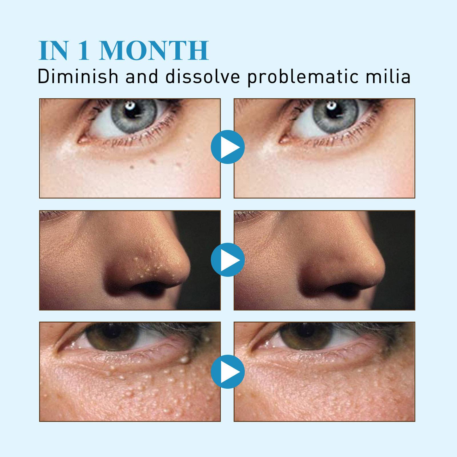 South Moon 144patch/Box Milia Remover Eye Cream Nourishing Moisturizing Repair Smoothing Eye Patches