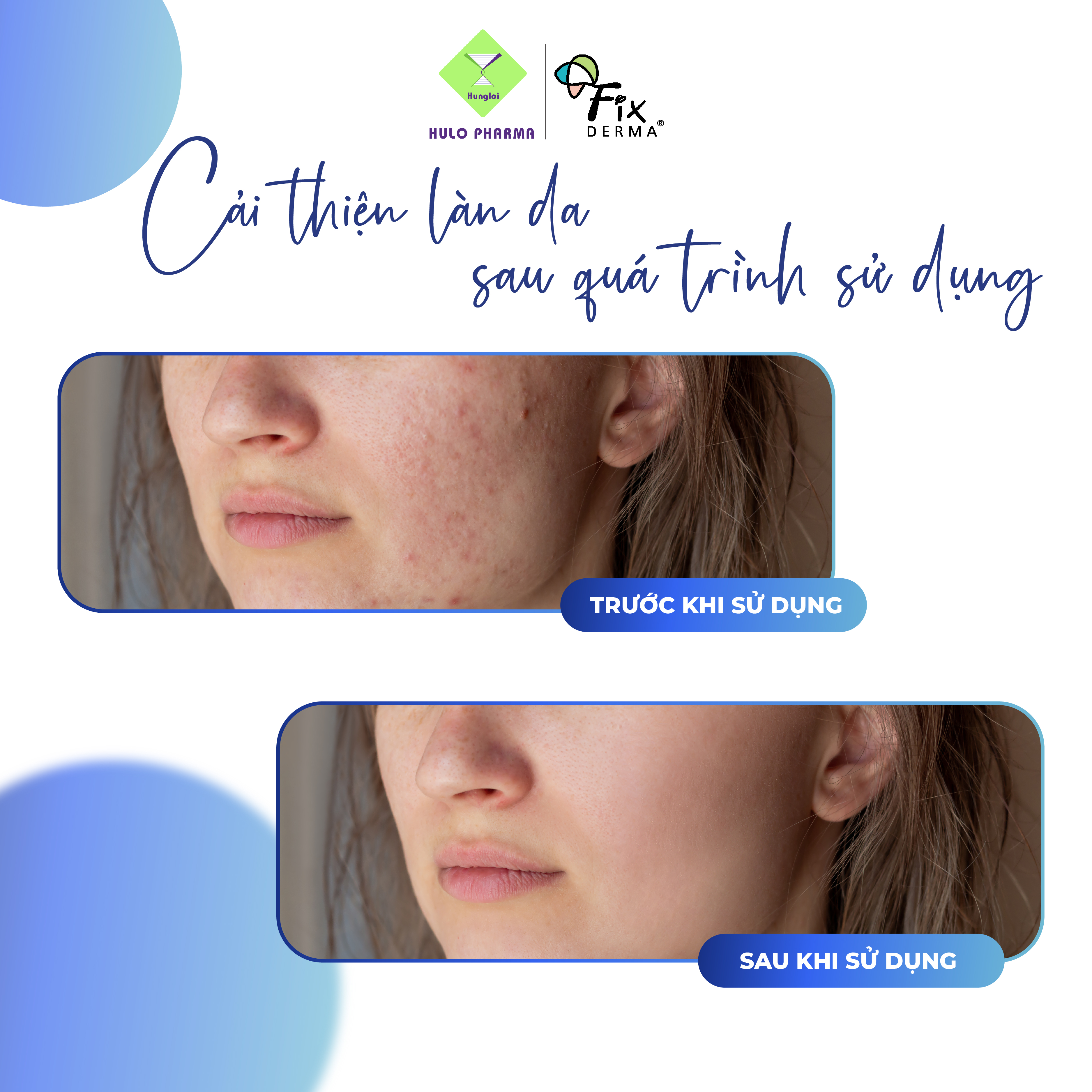 [ Hàng Tặng] Chấm Mụn FCL Alpha-Beta Acne Gel Giúp Giảm Mụn, Ngừa Viêm,Thông Thoáng Lỗ Chân Lông, Điều Tiết Bã Nhờn 30ml [Hùng Lợi]