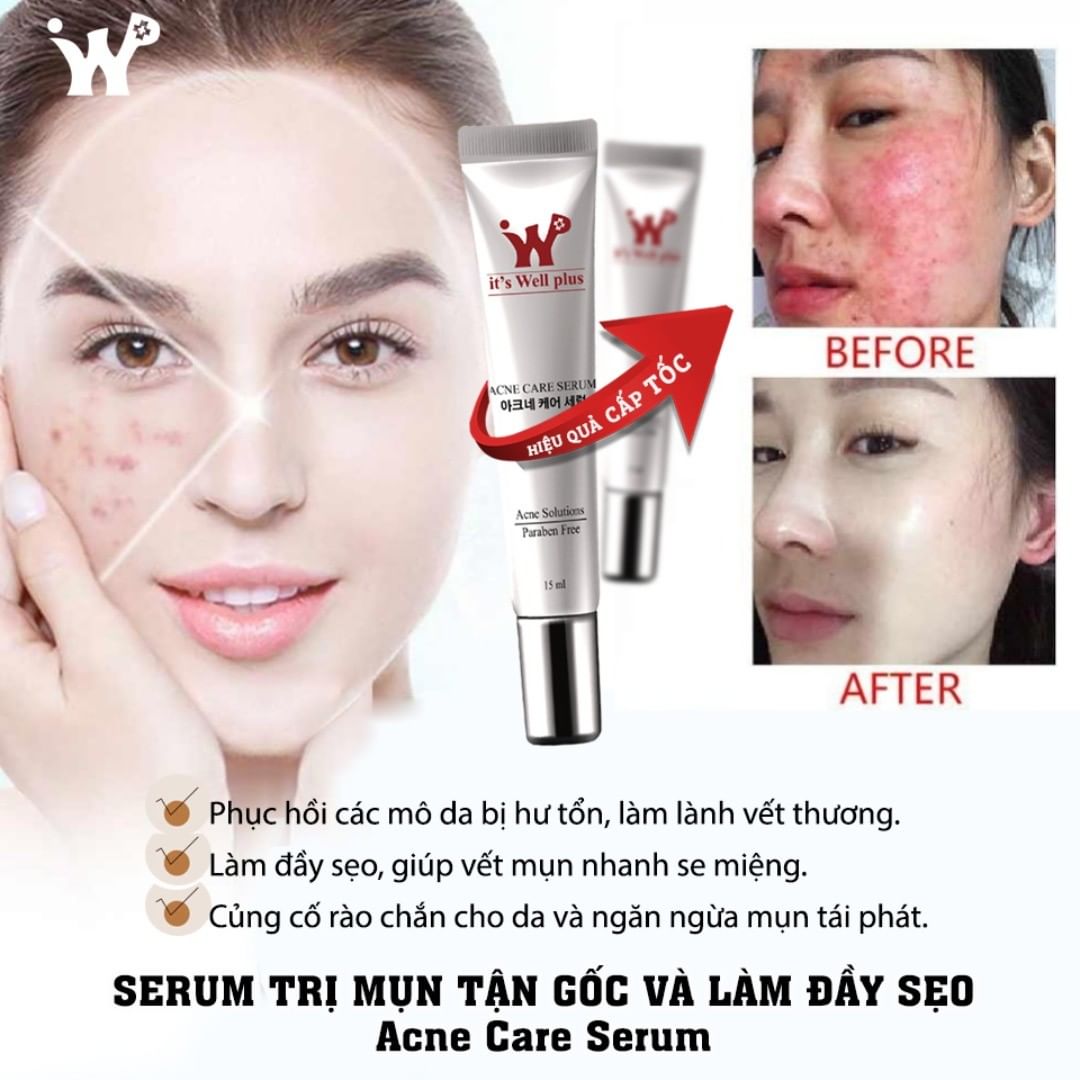 Serum Hỗ Trợ Làm Giảm Mụn It'S Well Plus Acne Care Serum 15ml