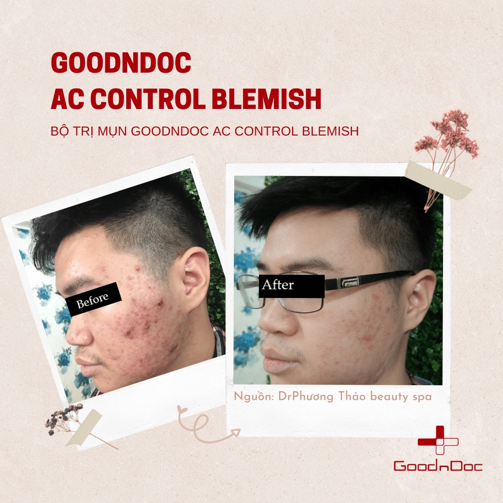 Bộ Sản Phẩm Chăm Sóc Chuyên Sâu Cho Da Mụn GoodnDoc AC Control Blemish