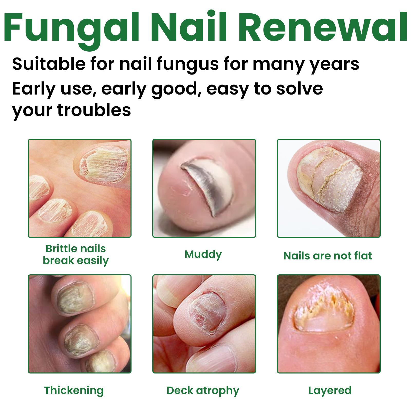 EELHOE 30ml Nail Treatment Essence for Onychomycosis Mild Non-irritating Nail Bright Shiny Repair Nail Repair Solution