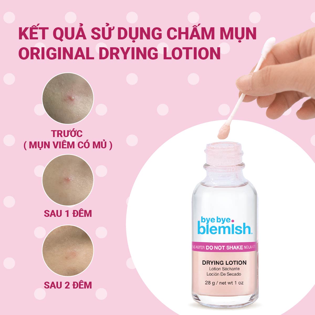 Bộ sản phẩm Chấm mụn và Tinh chất Peel da AHA + BHA Bye Bye Blemish giúp giảm mụn sưng đỏ, mờ vết thâm và tái tạo làn da