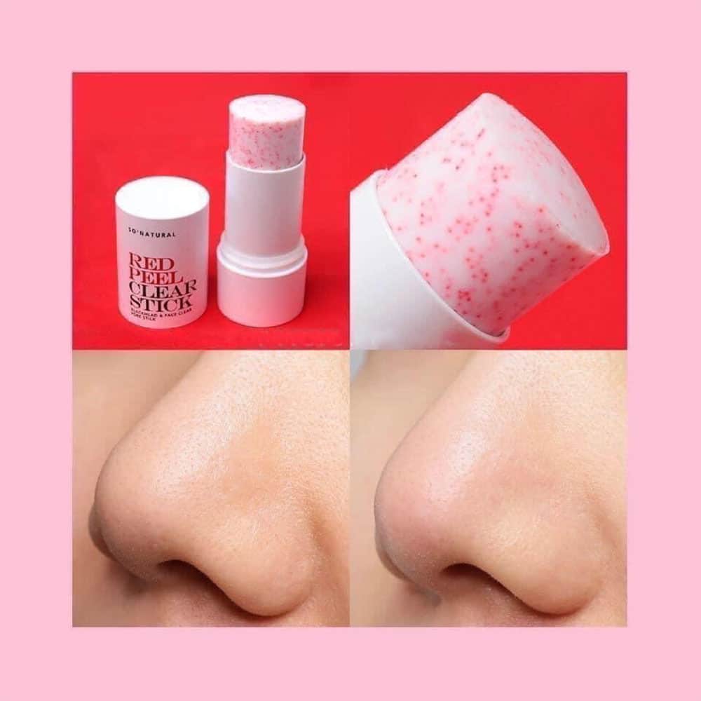 Sáp ngừa mụn So’Natural Red Peel Clear Stick Pore Blackhead &amp; Face 23g tặng kèm mặt nạ Su:m (màu ngẫu nhiên)